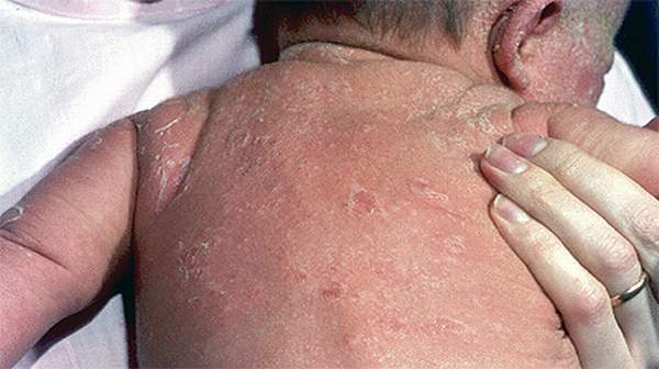 picture of scalded skin syndrome