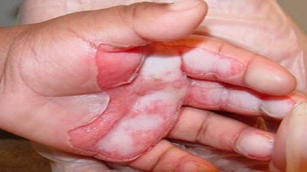 Picture of Baby Thermal Burns