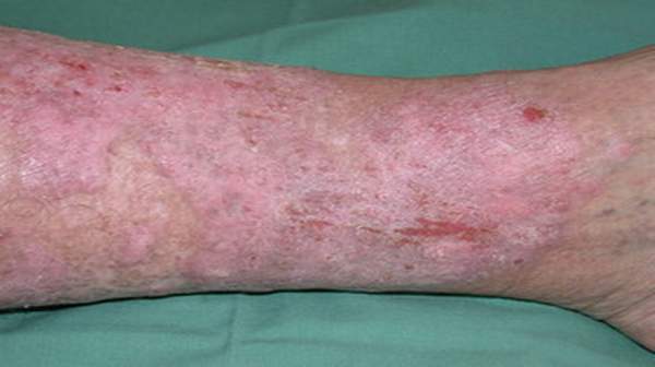 Picture of varicose eczema