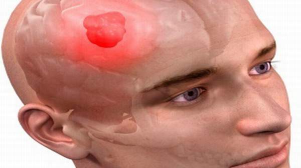 Picture of Brain Tumor