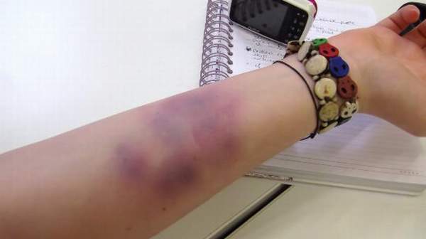Picture of Bruises on hands