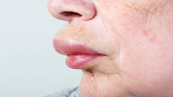 picture of Angioedema