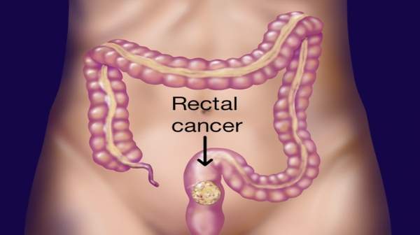 Picture of Rectal cancer
