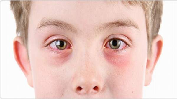 Hay fever in children