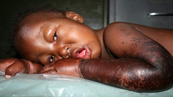 Picture of Kwashiorkor