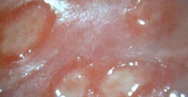 Genital Ulcer Sores in Female