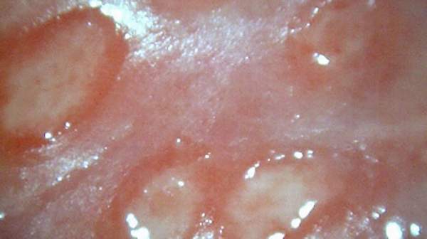 Genital Ulcer Sores in Female