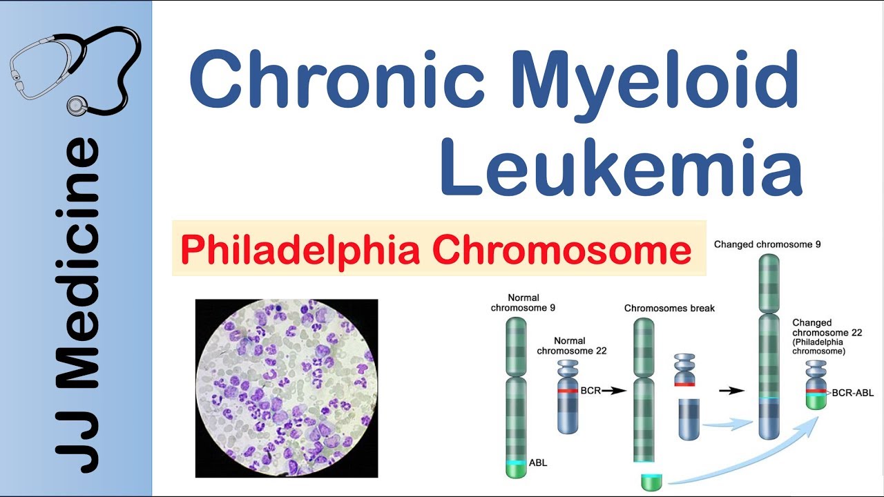 Chronic Myeloid Leukemia