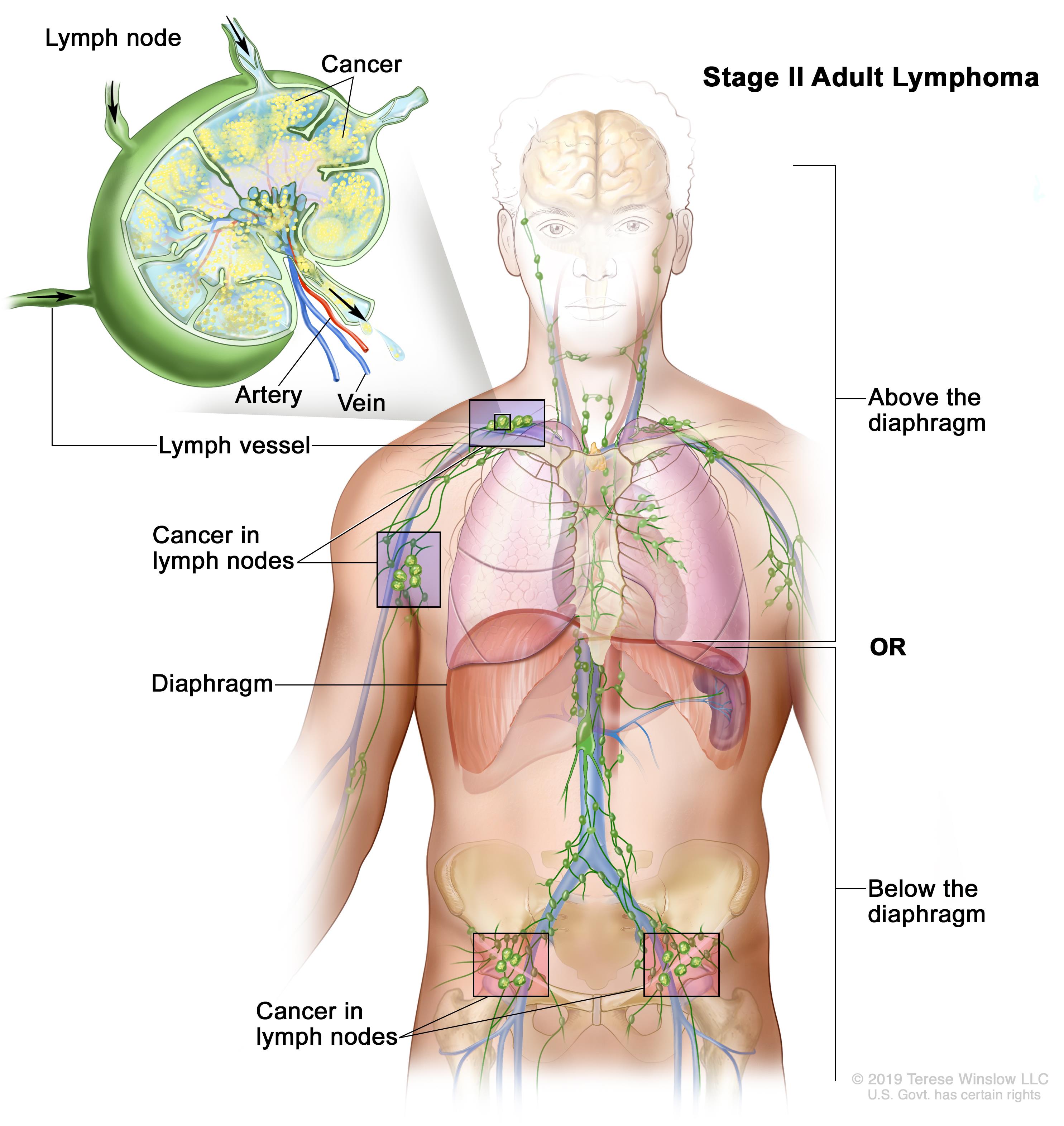 Non-Hodgkin lymphoma: Causes, Symptoms & Risk factors