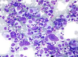 hodgkin lymphoma