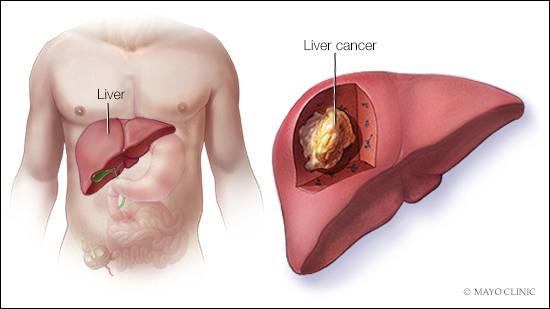 iver cancer symptoms, liver cancer survival, liver cancer survival rate, liver cancer stages, liver cancer life expectancy, liver cancer treatment, liver disease, metastatic liver cancer.