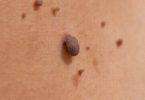Moles are a member of the family of skin lesions known as nevi.