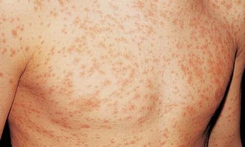 HIV Rash