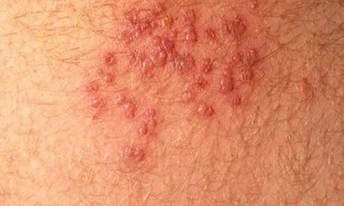 hiv rash picture