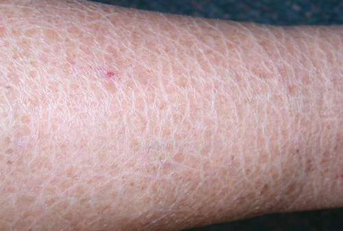 Ichthyosis vulgaris