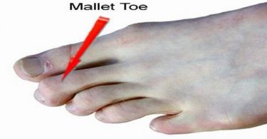 Mallet Toes