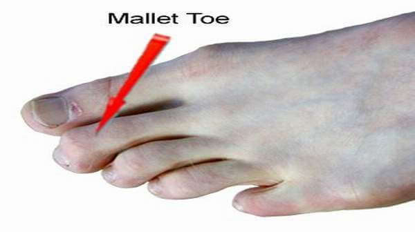 Mallet Toes