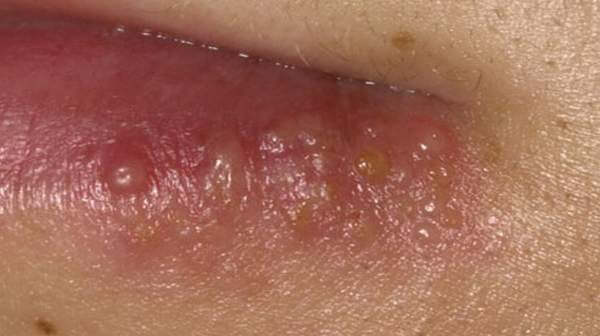 Picture of Herpes Simplex Virus Type 1