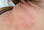 Hives on neck
