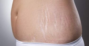 Home Remedy for Remove Stretch Marks