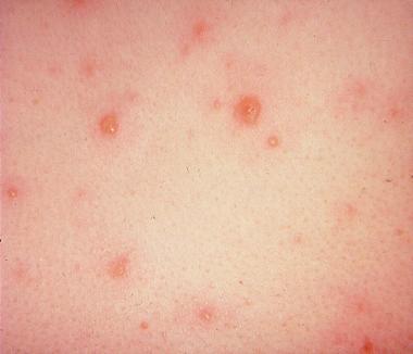 Difference Between HIV Rash and Chickenpox