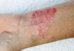 Scabies images