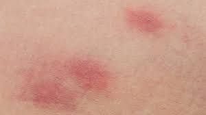 Scabies images