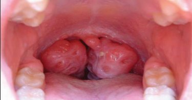 how do you get tonsillitis
