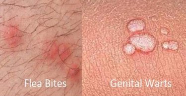 How can you tell Flea Bites from Genital Warts