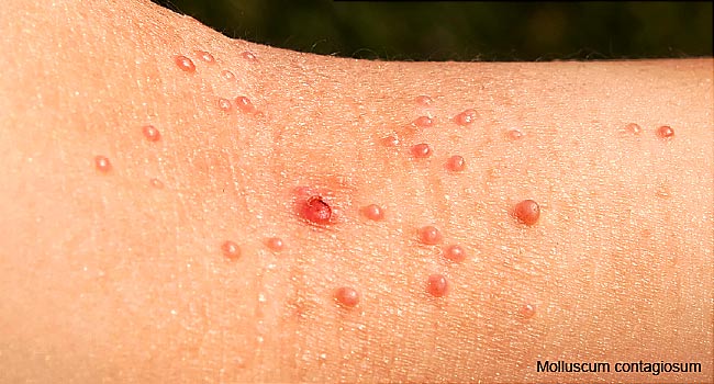 characteristics of hiv rash