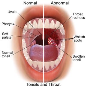 Symptoms between HIV and Tonsillitis