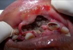Oral Myiasis Causes, Treatments, Videos Photos
