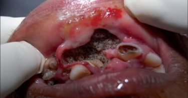 Oral Myiasis Causes, Treatments, Videos Photos