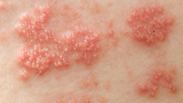 Shingles, rash