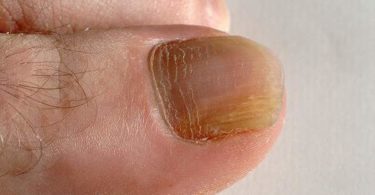 how to prevent toe nail fungus