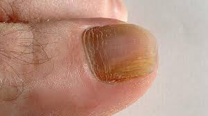 how to prevent toe nail fungus
