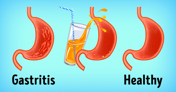 Gastritis