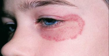 Ringworm: Facts, Causes, Symptoms & Treatments