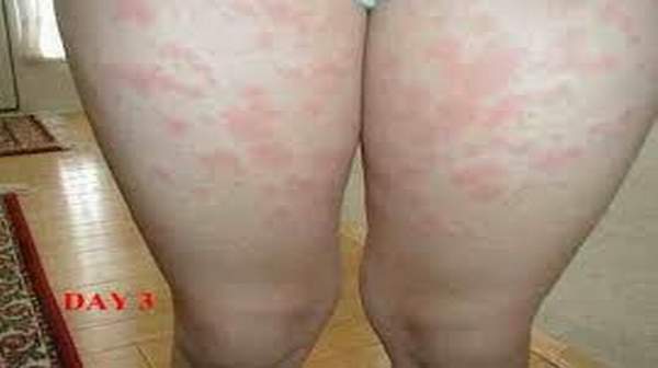 Mild Hiv Rash