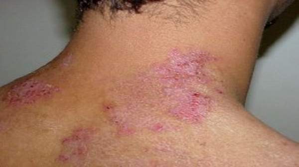 picture of Chronic Skin Conditions