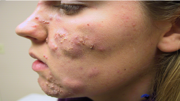 picture of Rosacea
