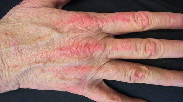 Picture of Dermatomyositis