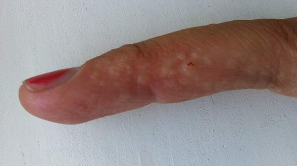 Picture of Dyshidrotic eczema