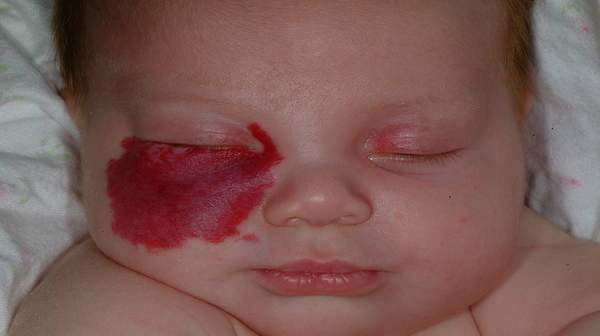 picture of Hemangioma