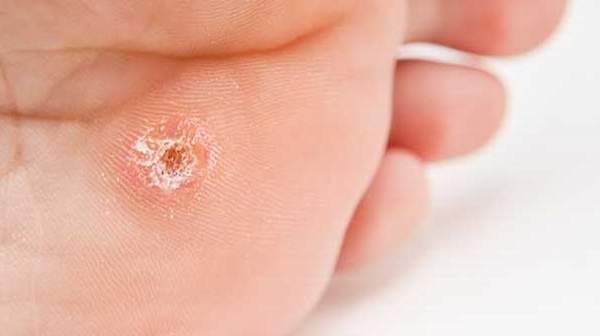 Picture of Calluses