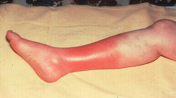 picture of cellulitis