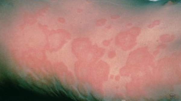 picture of hives rash