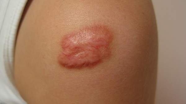 picture of Keloid-of-upper-arm