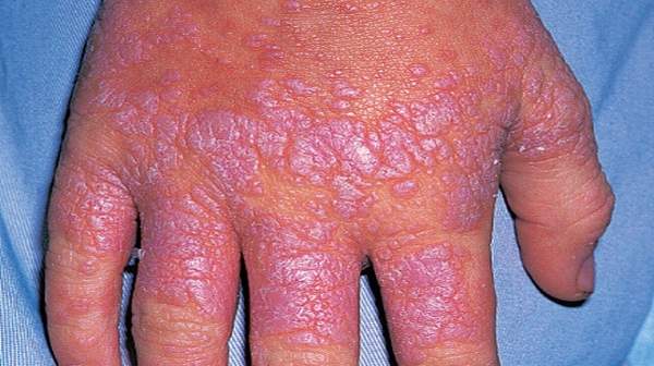 Picture of Lichen planus