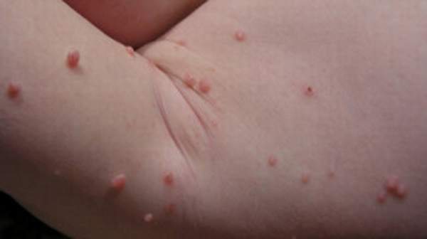 picture of Molluscum Contagiosum